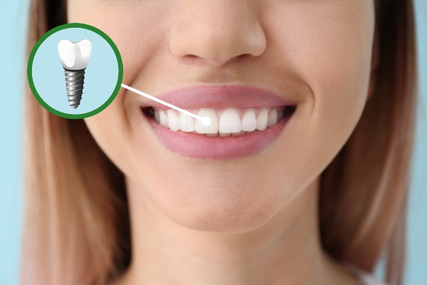 How Do I Know If I Need Dental Implants?